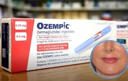 Novo efeito colateral do Ozempic chama atenção: ‘Boca de Ozempic’