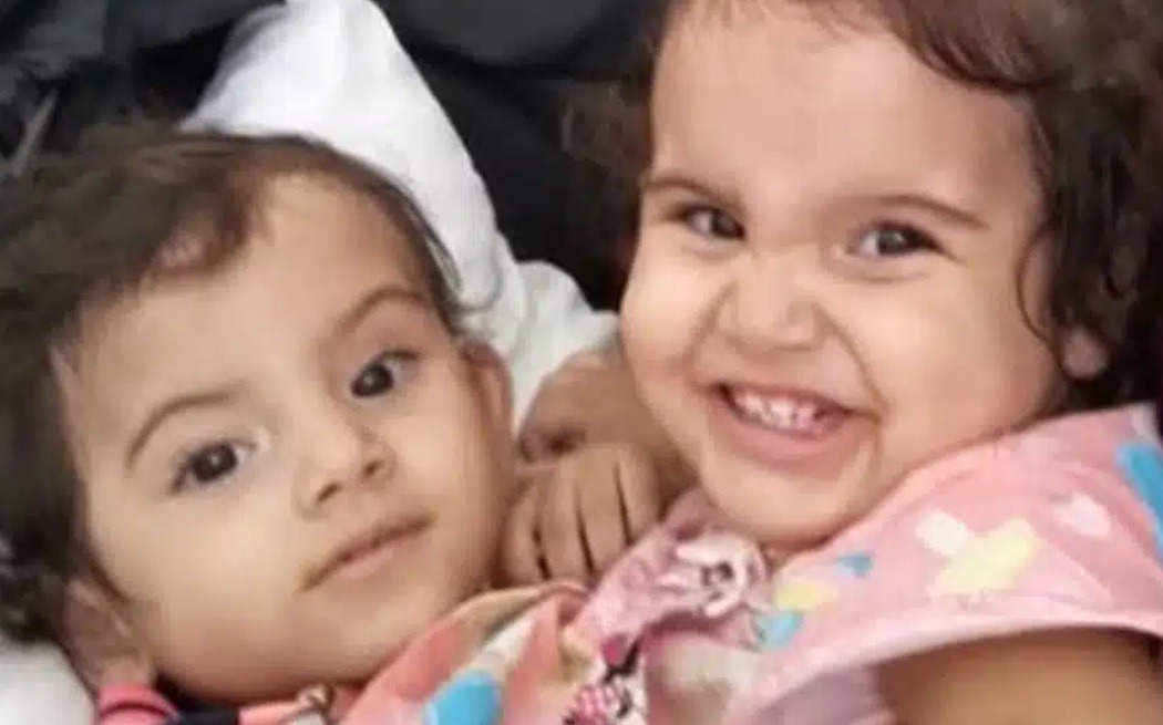 Pais dão adeus a gêmea siamesa 9 dias após ser separada