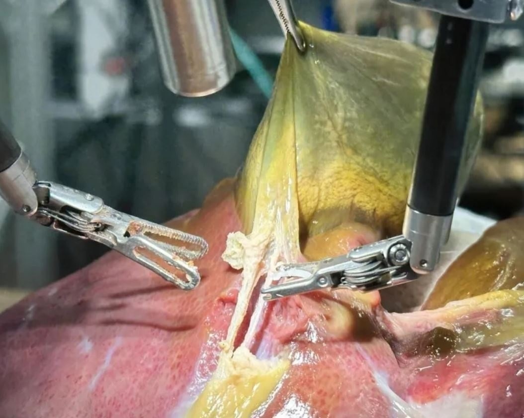 Pela primeira vez na história, robô faz cirurgia guiado por IA sem ajuda humana