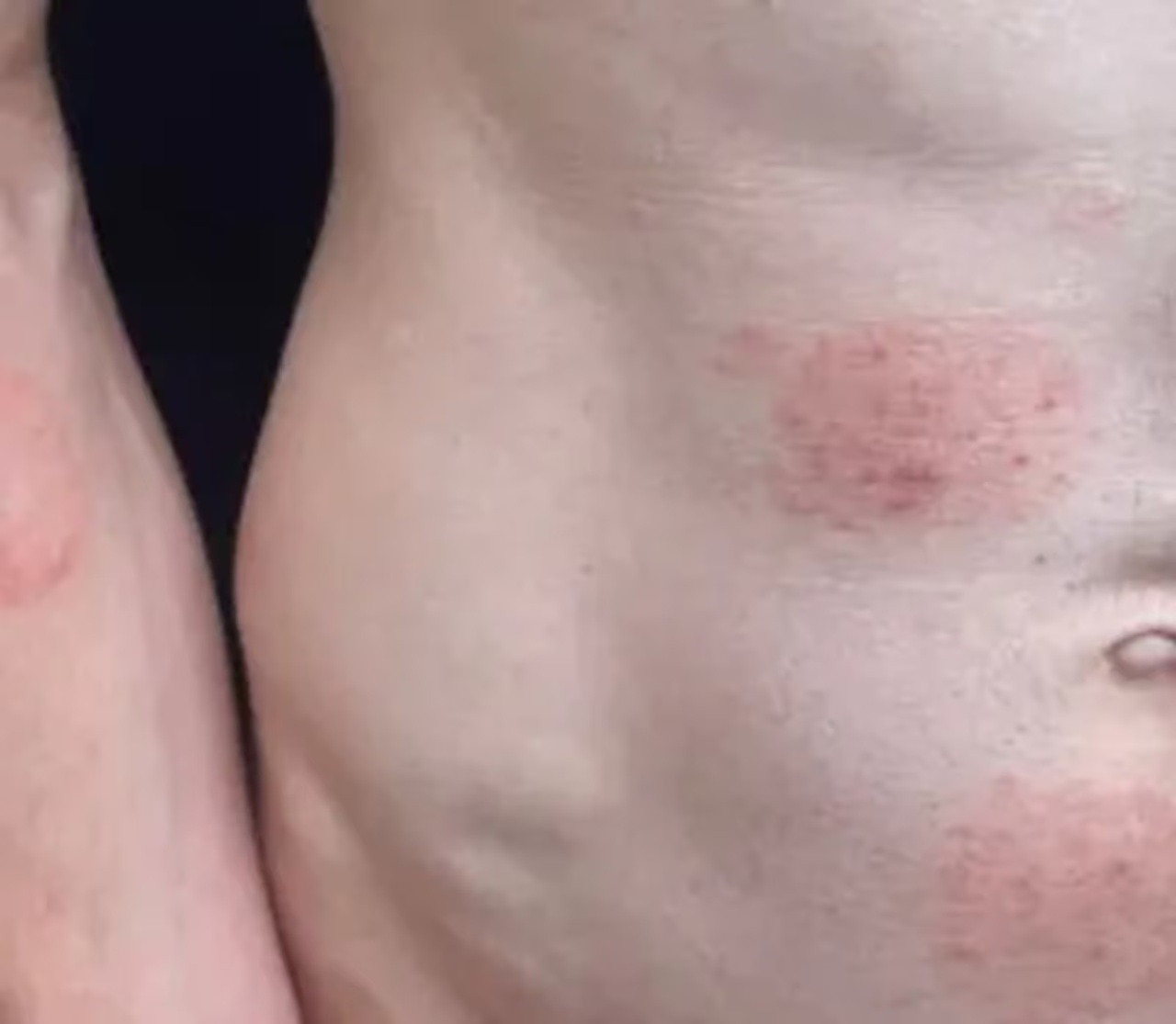Fungo ‘altamente contagioso’ transmitido por via sexual gera alerta em diversos países