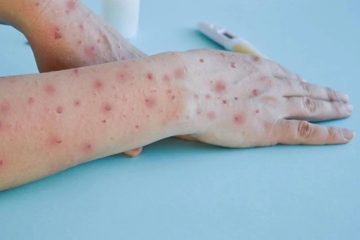 RN investiga caso suspeito de mpox em Mossoró