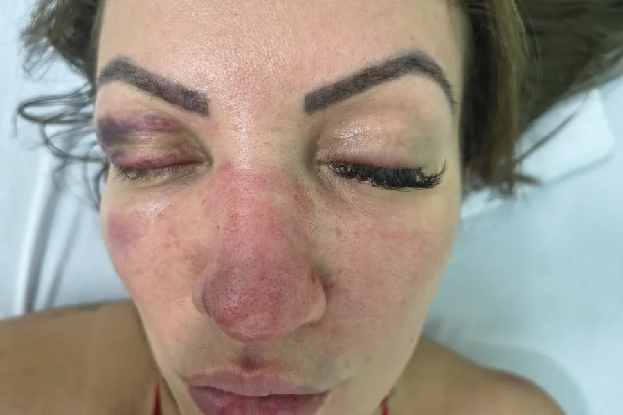Vereadora atropela namorado após ser espancada por ele