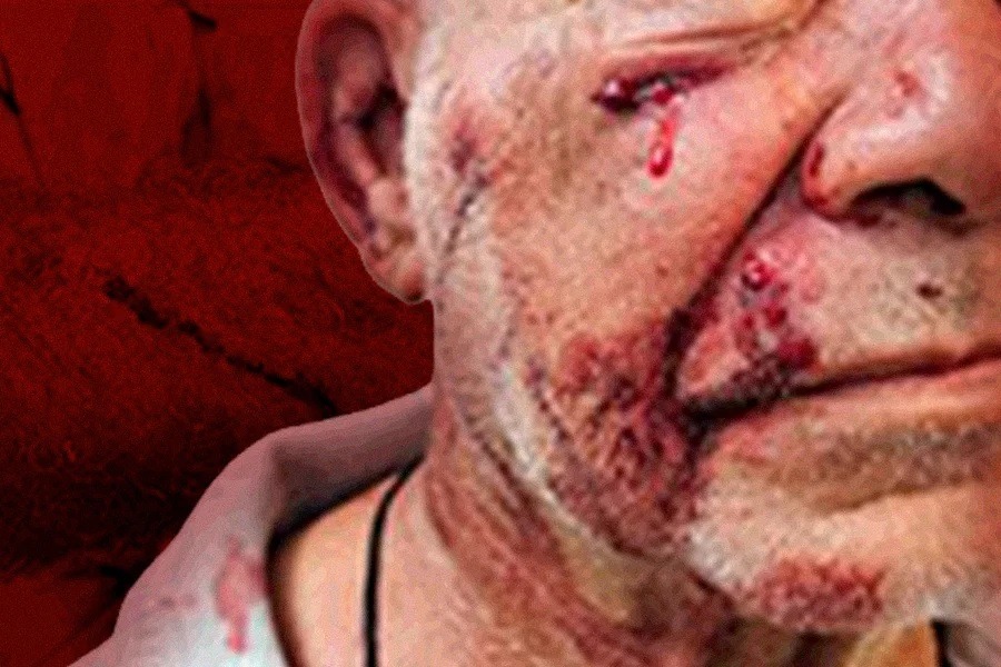 Veja como ficou servidor de 73 anos agredido por policial no INSS