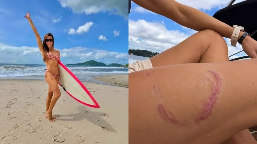 Após 50 dias, surfista mordida por tubarão em Noronha retorna ao mar