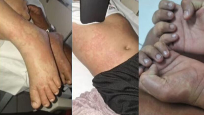 Infectologista diz que estado de menina internada em Natal não condiz com bactéria encontrada em detergente Ypê