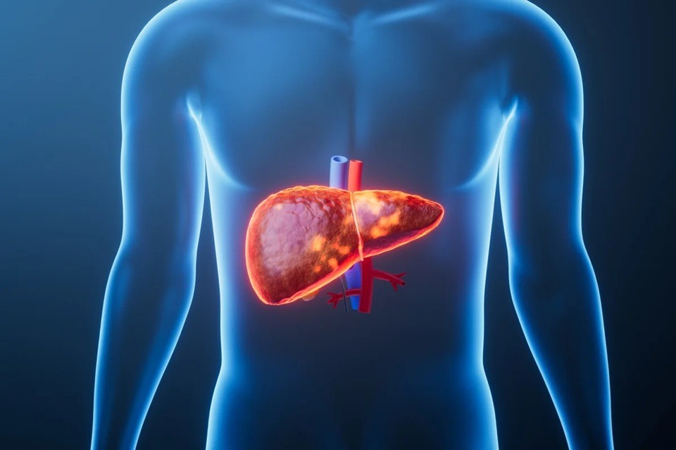 Hepatologista aponta o que ajuda a reverter a gordura no fígado
