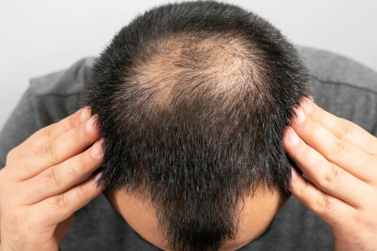 Calvície: veja o que é mito e o que é verdade sobre os shampoos