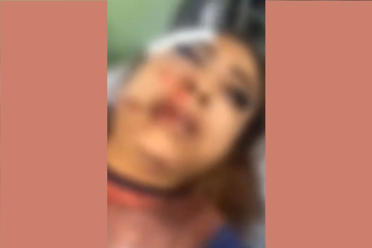 Garota de programa fica com o rosto desfigurado após ser espancada por cliente