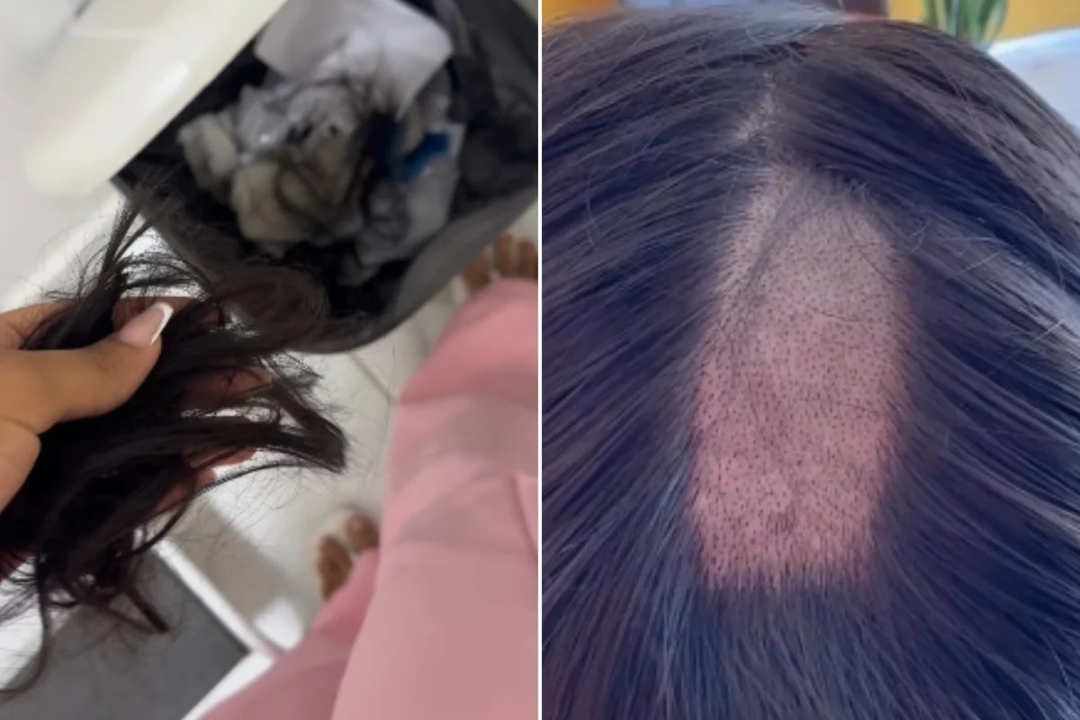Mulher acusa clínica de deixar "buraco" no couro cabeludo durante exame para CNH