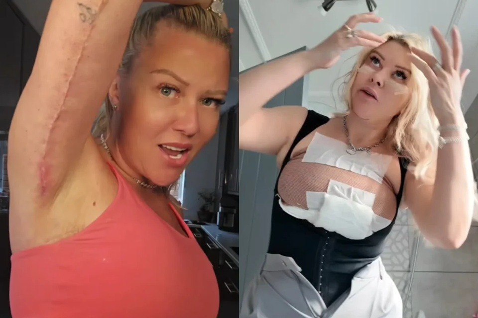 "Noiva de Frankenstein": mulher relata cirurgias feitas até na vagina