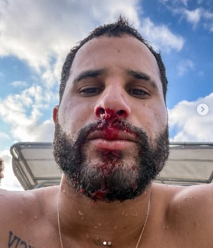 Surfista potiguar Ítalo Ferreira leva cinco pontos no nariz após acidente em Fiji