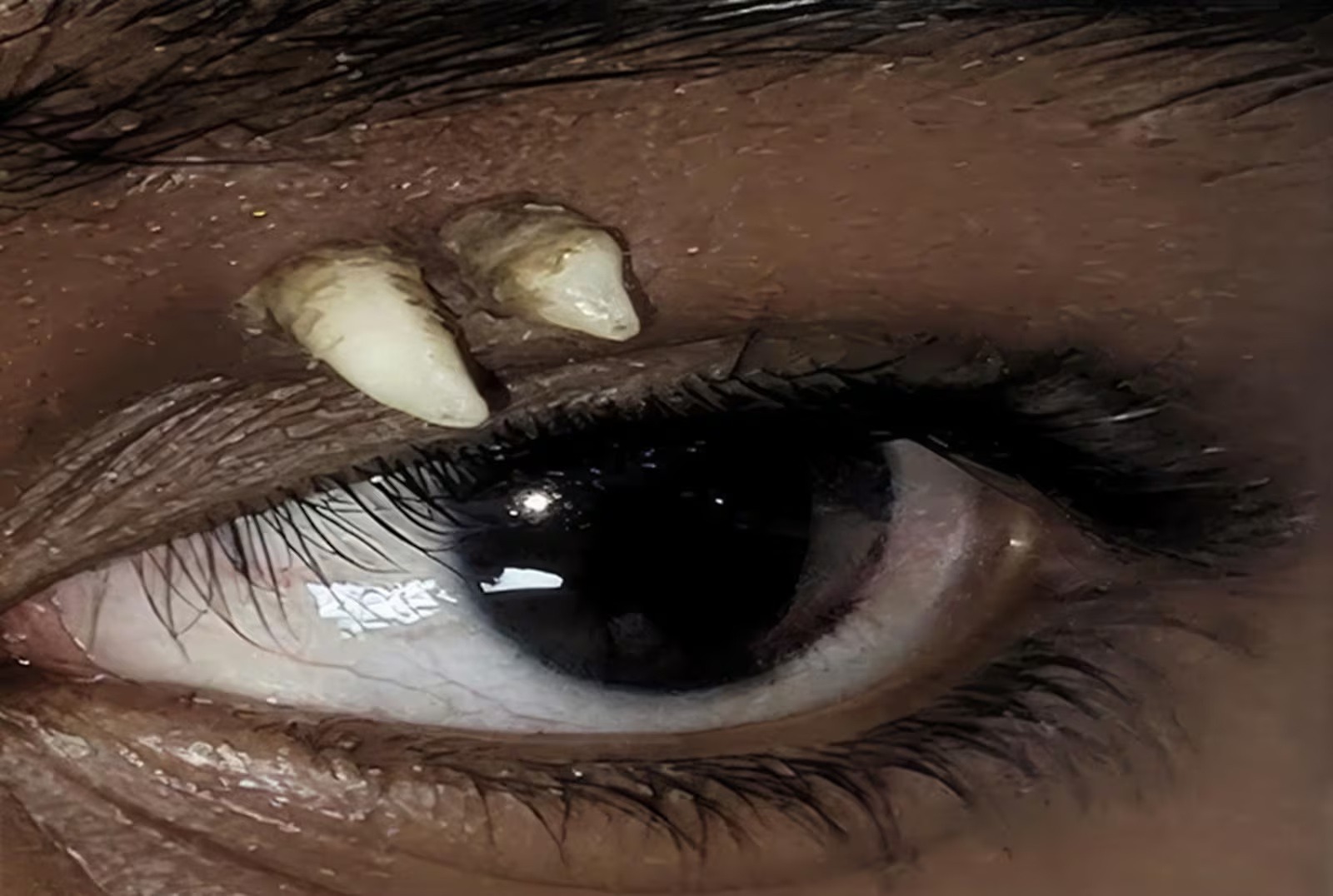Dente cresce acima do olho em primeiro caso registrado pela ciência