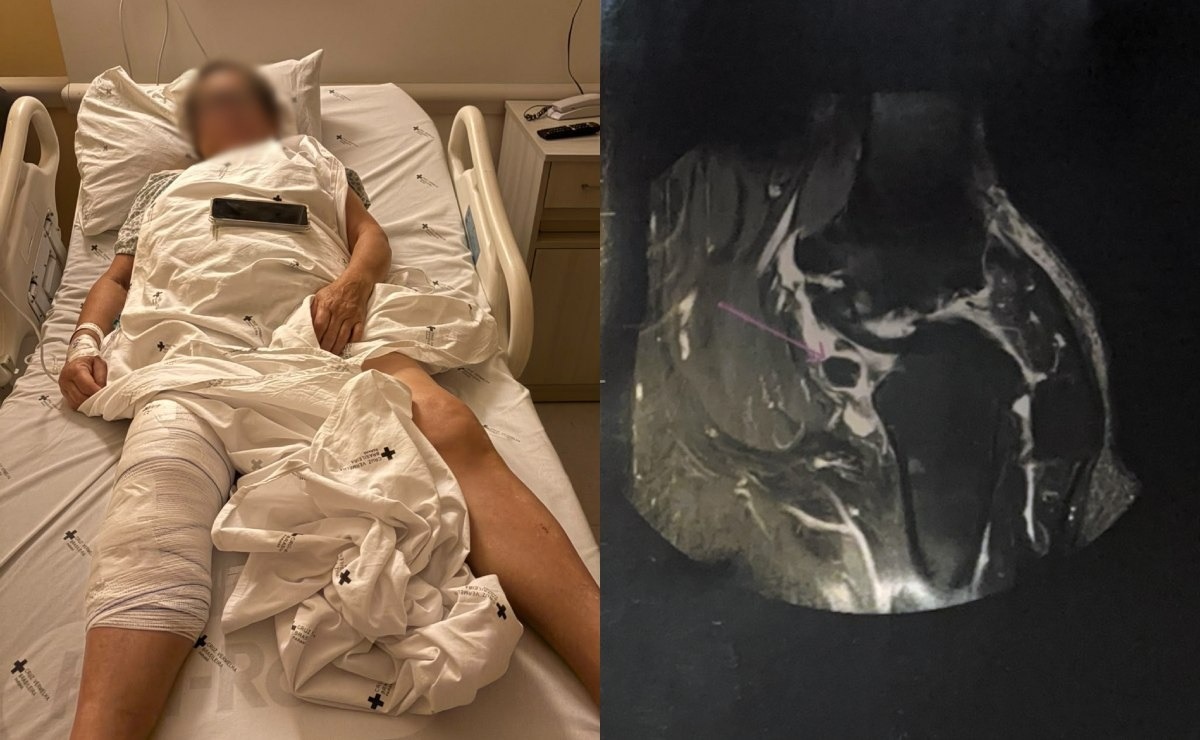 Idosa acorda de cirurgia e descobre que prótese foi colocada no joelho errado: “Erro absurdo”