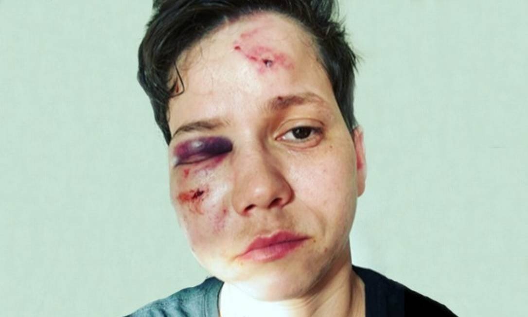 Youtuber Bolsonarista é espancada em ataque homofóbico e fica desfigurada