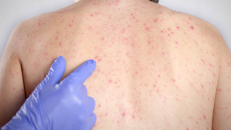 Mais dois casos de sarampo são registrados no RN, diz Secretaria de Saúde