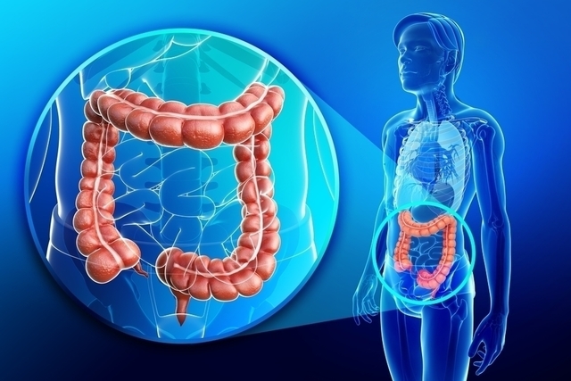 Saiba as principais causas do câncer de intestino