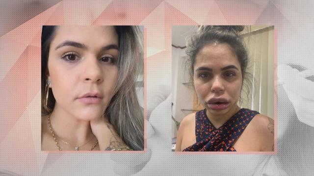 Mulheres denunciam dentista após harmonização facial deixar rostos deformados