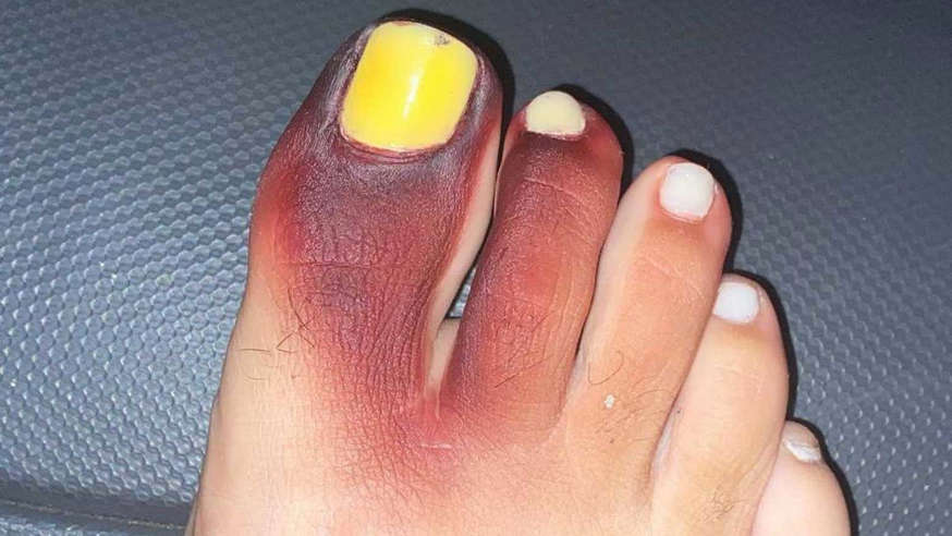 Jovem se desespera ao ver como ficou seu pé após calçar tênis com "piolho de cobra" dentro
