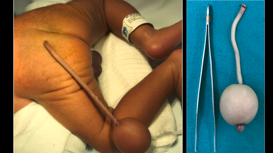 Bebê brasileiro nasce com ‘cauda’ de 12 centímetros e bola na extremidade