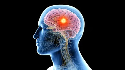 Tumores cerebrais: Veja como identificar os seus sintomas e quais são os riscos de desenvolver