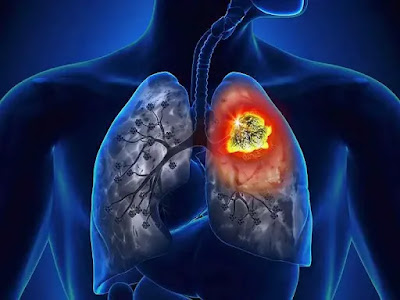 Confira os sintomas e fatores de risco para o câncer de pulmão, mais de 30 mil brasileiros são diagnosticados por...