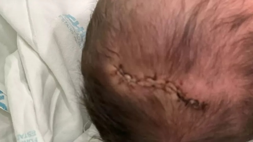 Bebê cai de cabeça após parto, leva 11 pontos e mãe aponta negligência