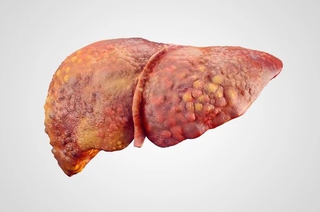 VÍDEO: Veja os 8 principais sintomas de gordura no fígado e como tratar