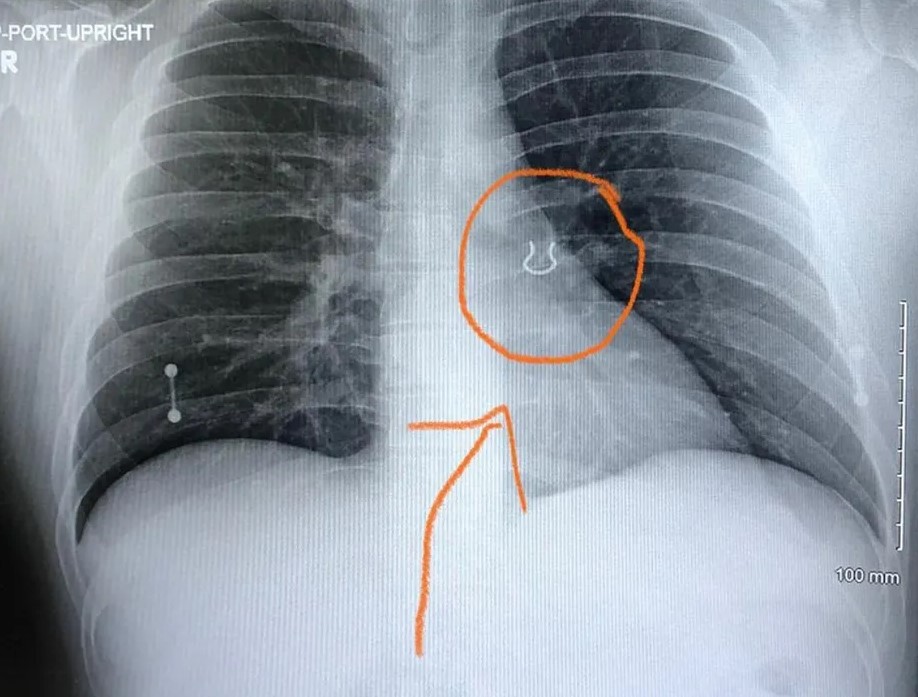 Médicos encontram piercing de nariz perdido há cinco anos alojado no pulmão de paciente