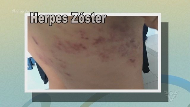 Entenda o que é Herpes Zoster e quais os principais sintomas da doença
