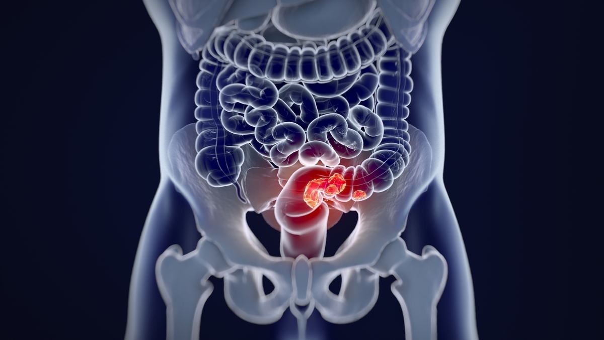Veja sinais do câncer de intestino, cada vez mais comum antes dos 50 anos