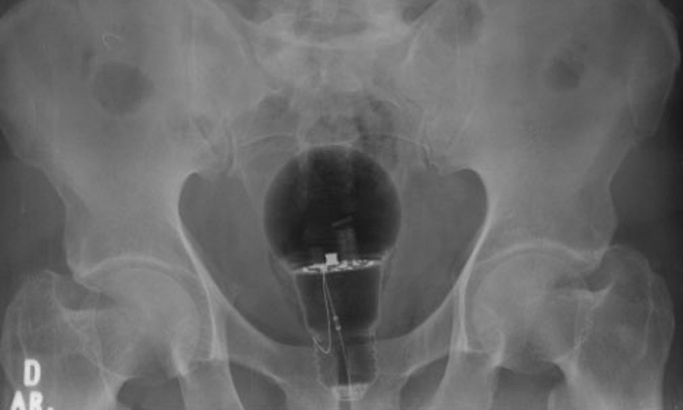 Lâmpada é retirada do ânus de paciente na Colômbia e raio-x choca internautas; veja imagem