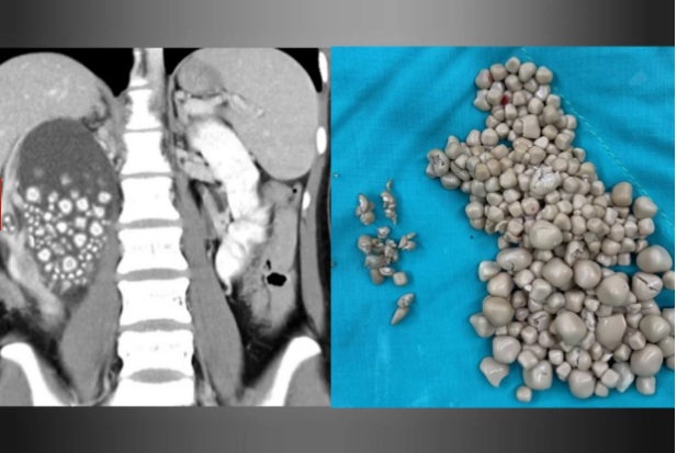 Médicos retiram 300 pedras do rim de mulher que não tomava água